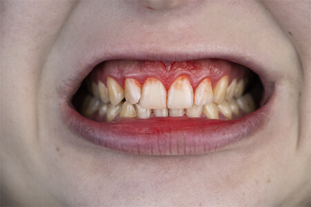 Zahnfleischblutung und Entzündung - Gingivitis