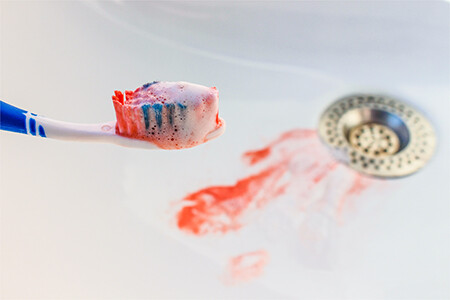 Blut beim Zähneputzen