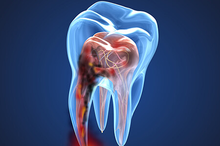 3D-Darstellung eines beschädigten Zahns