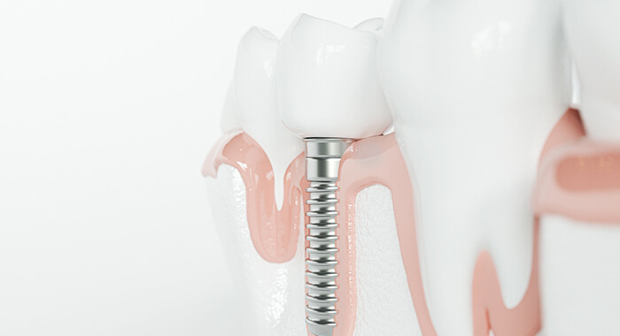 Gesunde Zähne und ein Implantat